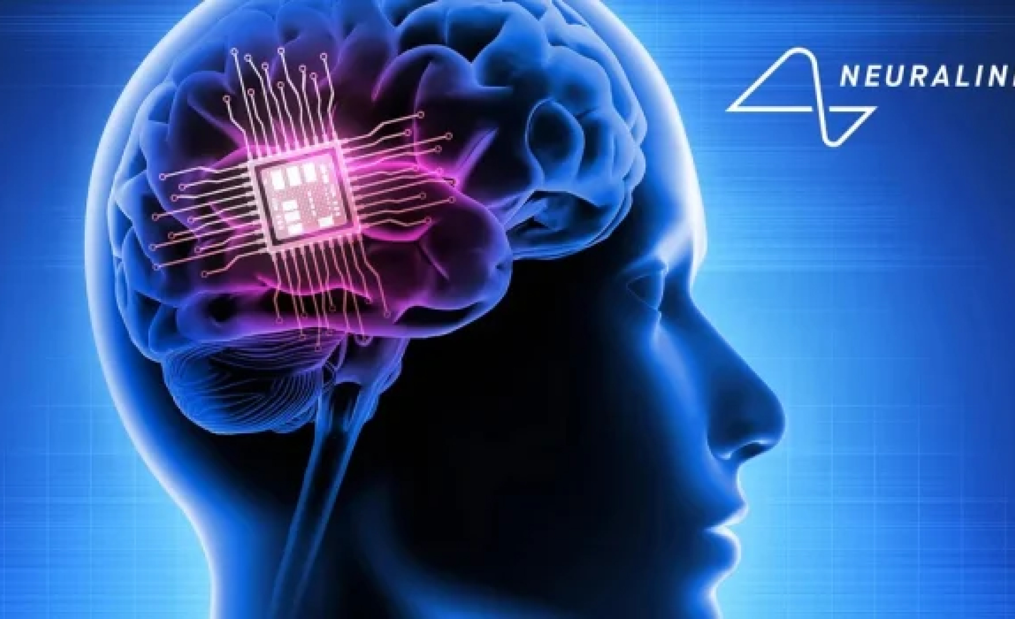 Mood-enhancing-brain-chip-enters-clinical-trial-stage